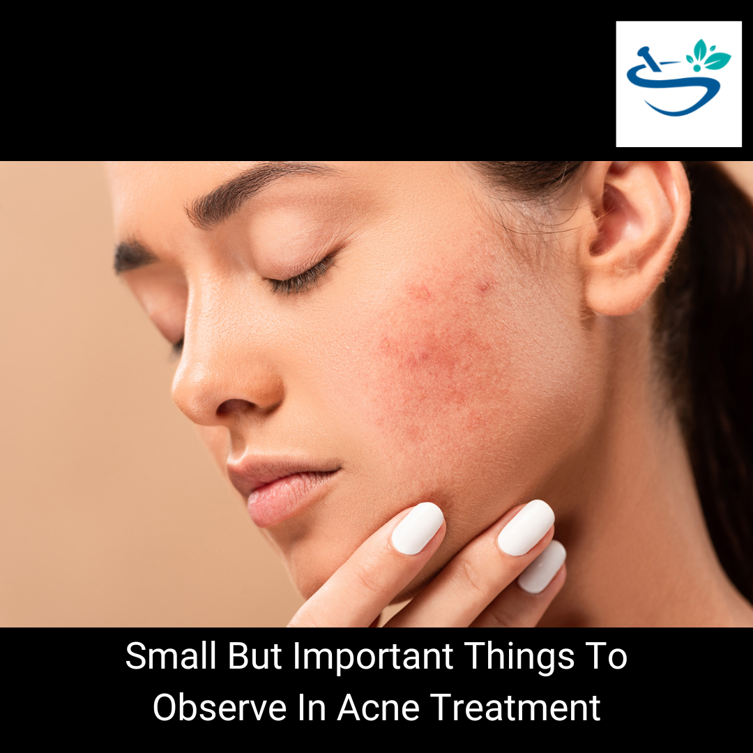 small but important things to observe in acne treatment
