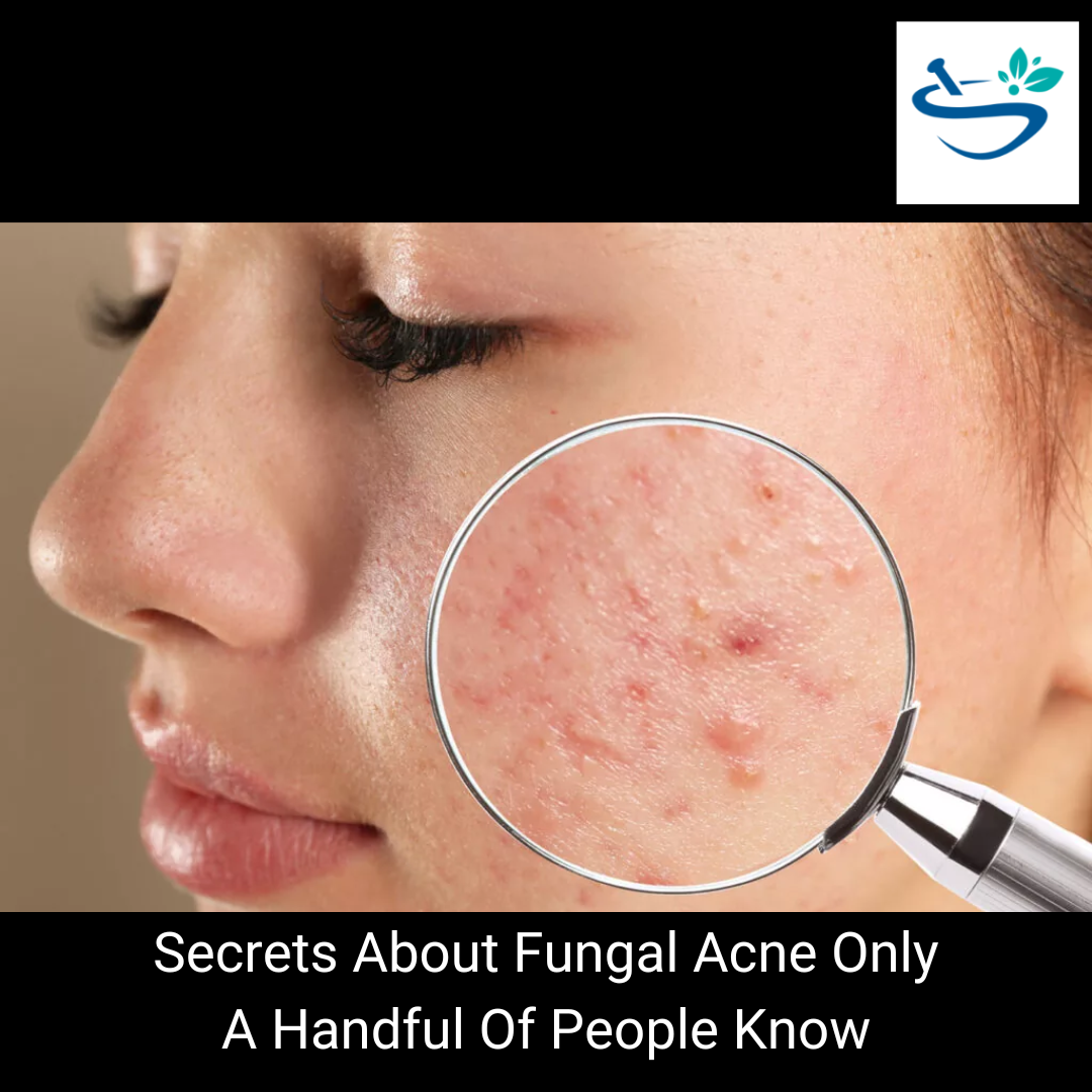 Secrets About Fungal Acne Only A Handful Of People Know