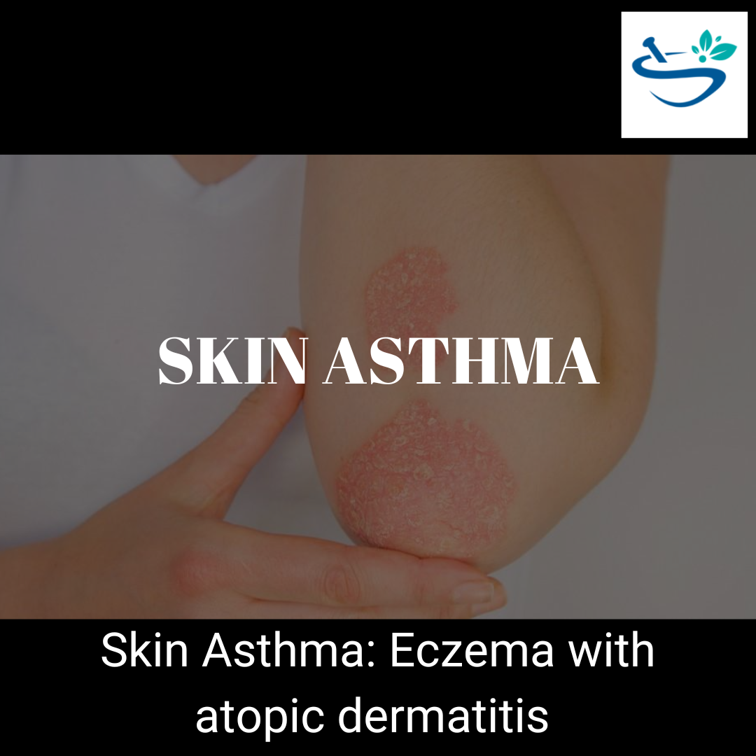 Relieve Skin Asthma Symptoms with Our Effective Treatment Solutions