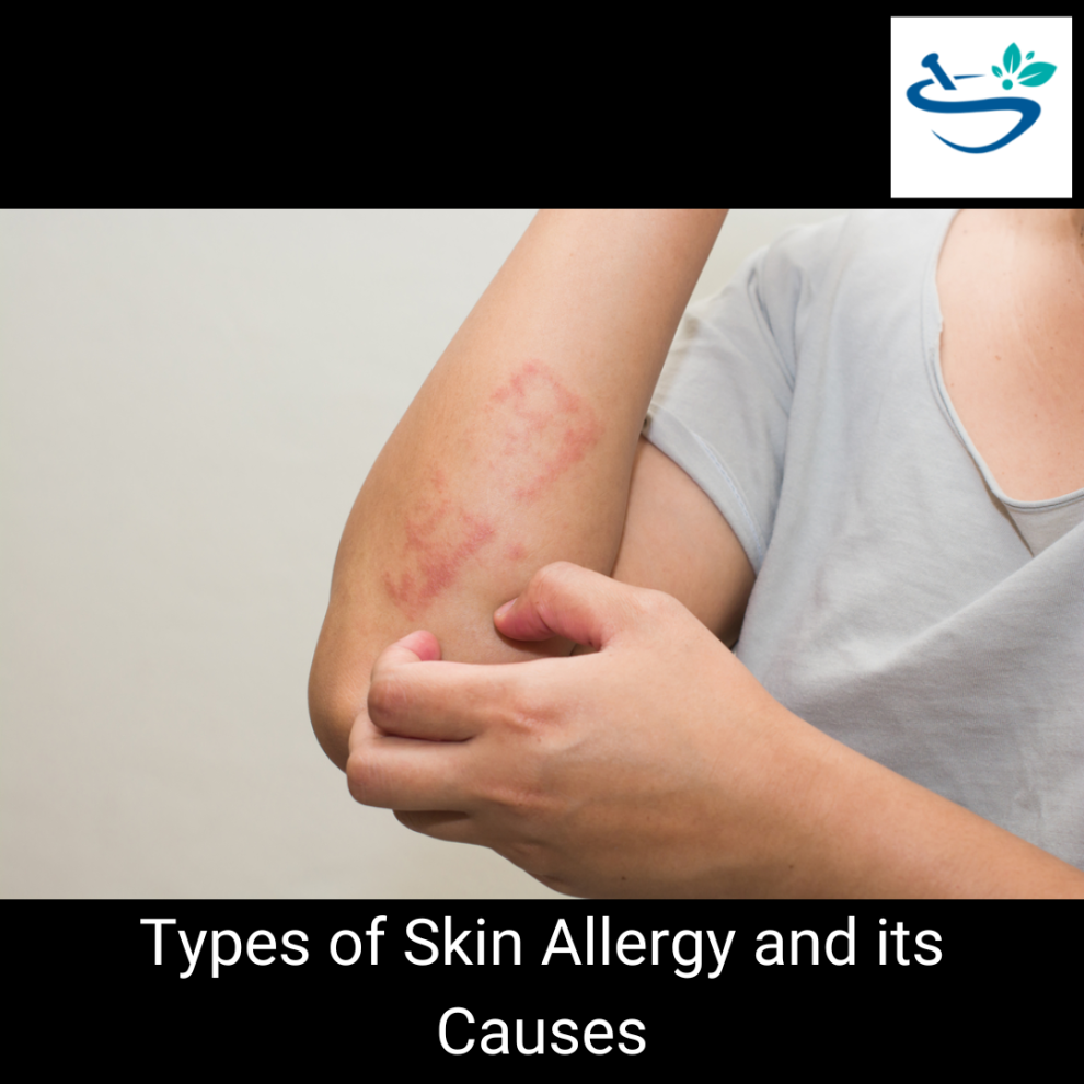 Skin Allergy Types: A Comprehensive Guide