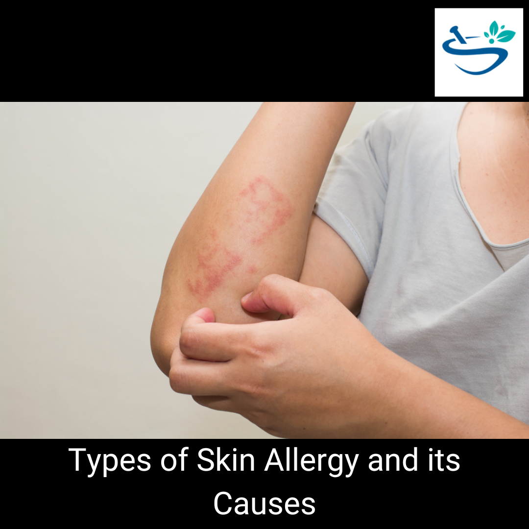 Understanding Different Types of Skin Allergies: A Comprehensive Guide