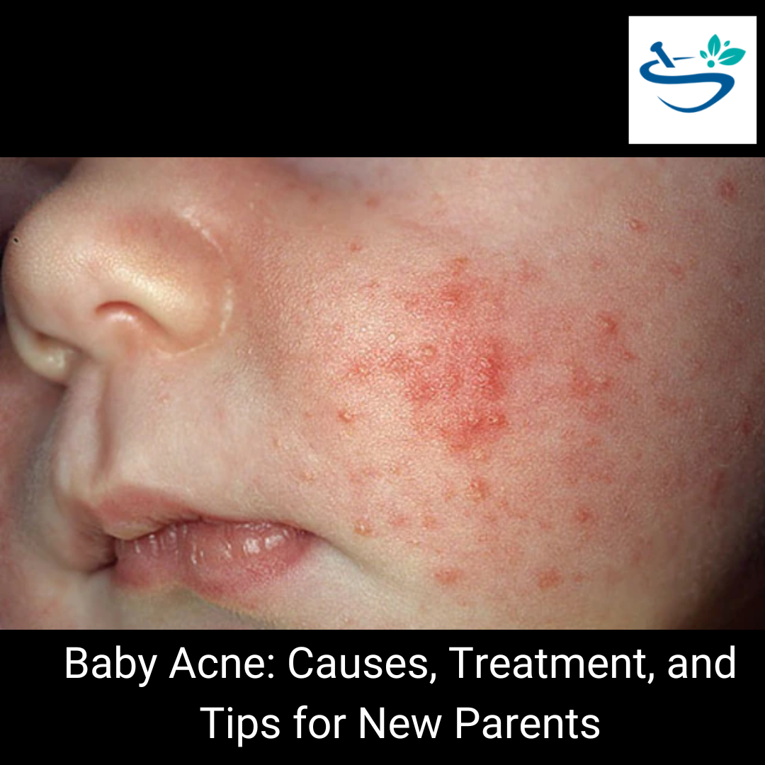 Baby Acne with Gentle and Effective Solutions